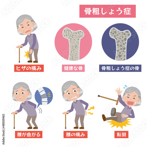 骨粗しょう症の高齢女性イメージ