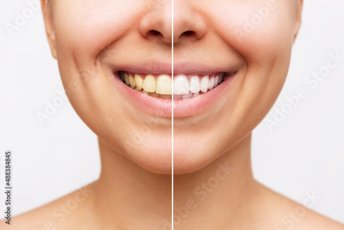 Fototapeta Cropped shot of a young smiling woman before and after teeth whitening isolated on a white background