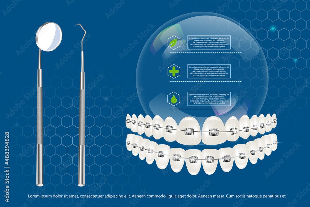 3d vector illustration, realistic teeth with upper and lower jaw braces ...