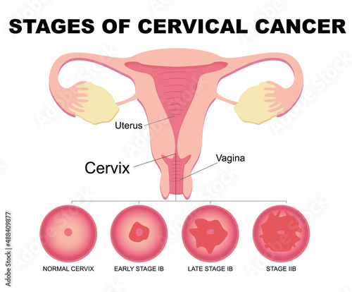 Flat illustration of cervical cancer stages. Diseases of the female reproductive system.Cervical canal, cervix, vagina. Carcinoma, malignant neoplasm.Biology, anatomy, medicine and scientific concept. photo