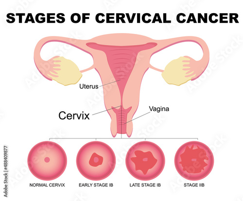 Flat illustration of cervical cancer stages. Diseases of the female reproductive system.Cervical canal, cervix, vagina. Carcinoma, malignant neoplasm.Biology, anatomy, medicine and scientific concept.