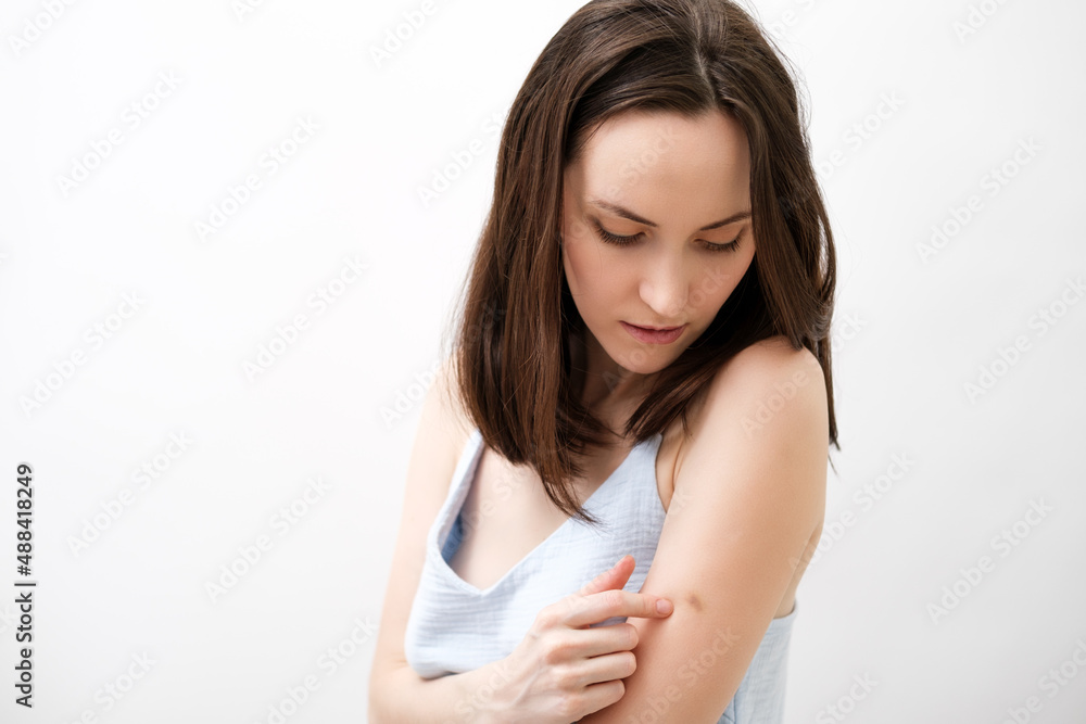 portrait of brunette woman in blue T-shirt with bruise on her arm portrait of brunette woman in blue T-shirt with bruise on her arm