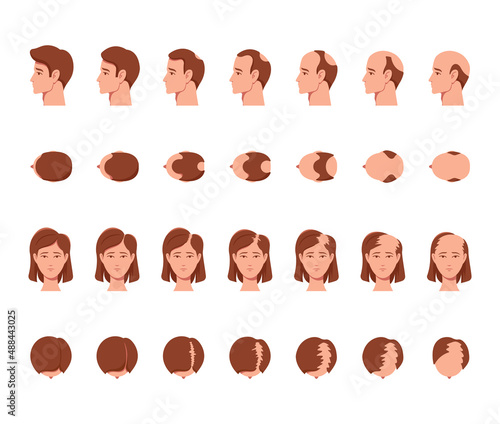 Stages of Baldness of Men and Women. Male and Female Characters Head Top, Side and Front View with Hair Loss Process