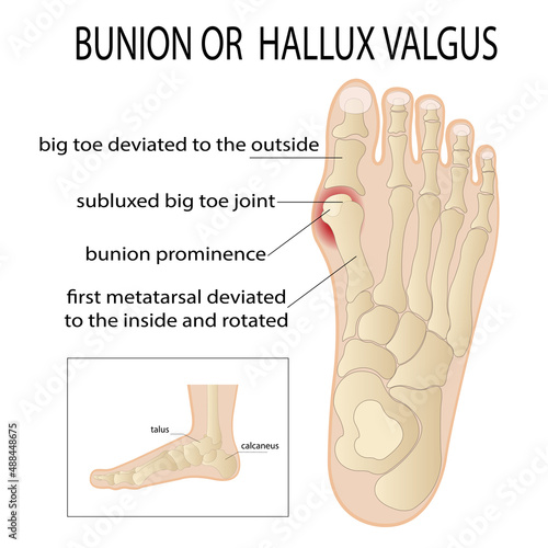 Bursitis on the sides of the foot. The bone and skin on the sides of the big toe joint form an abnormal foot shape. Common problem