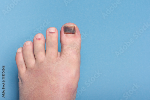 Injury to the nail of the big toe, hematoma and bruising under the nail. photo