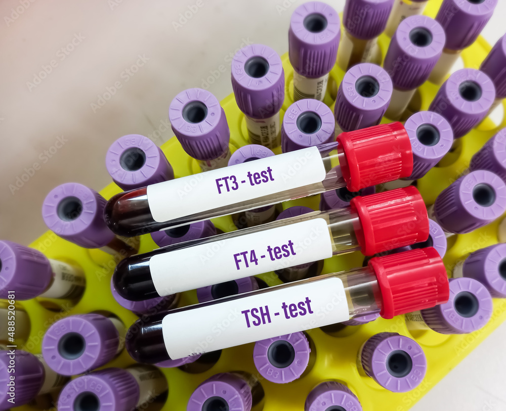 Blood sample for Thyroid panel hormone test for FT3, FT4, TSH with