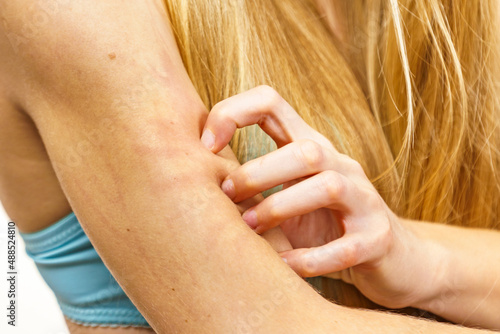 Photography Woman scratching her itchy arm. Skin allergy.