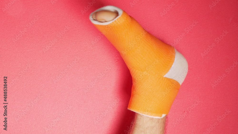 Foot with broken toe bone in orange fiberglass cast pink background ...