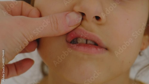 The child has stomatitis on the tongue. Selective focus. photo