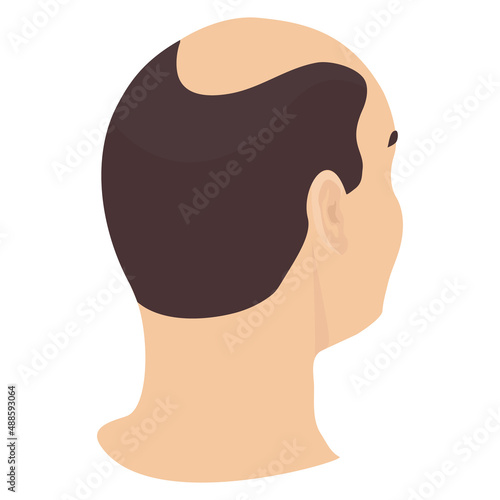 Head of a man with hair loss in side view. Different stages of alopecia in men. Health care and beauty concept. Vector cartoon illustration