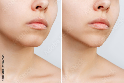 Сhin reduction. Cropped shot of woman's face with chin before and after mentoplasty isolated on a white background. The result of cosmetic plastic surgery. Beauty concept