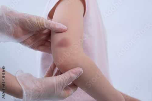 The doctor palpates the child's elbow. The traumatologist examines the site of injury. There is a bruise on the child's arm. Elbow injury