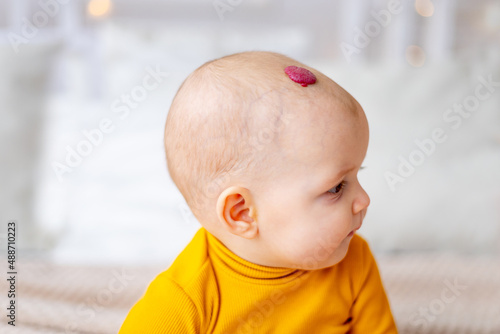 a baby with a hemangioma or a red benign tumor on the head from birth, portrait or close-up photo