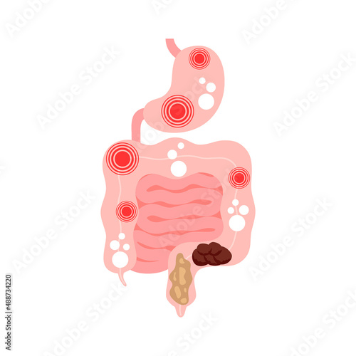 Irritable bowel syndrome, IBS. Symptoms in intestine and stomach pain, bloating, flatulence and diarrhea. Vector illustration