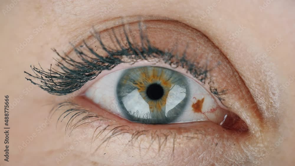 Mole on the eyeball. Human eye freckle, nevus under a microscope vídeo