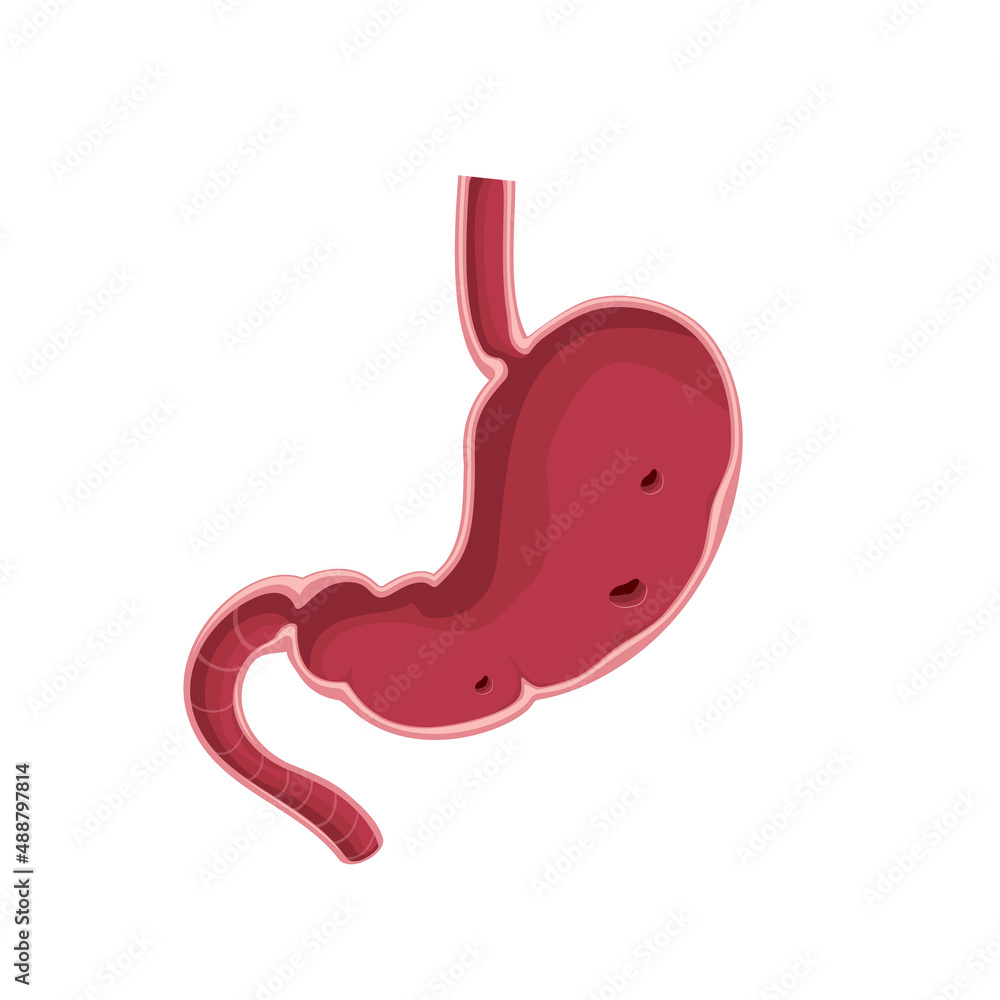 Stomach cross section, erosive gastritis illustration on white Stomach cross section, erosive gastritis illustration on white