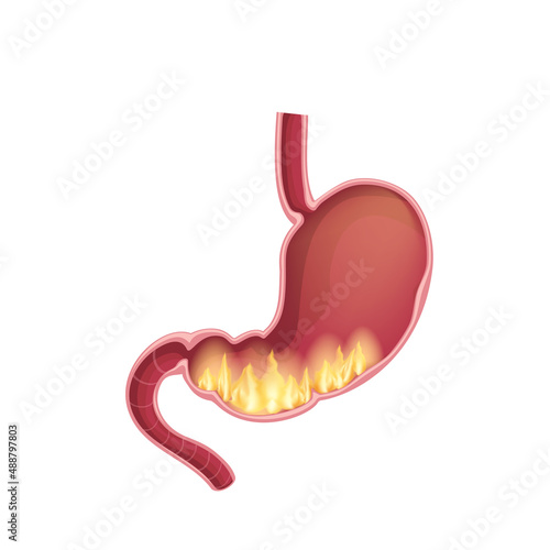Realistic medical illustration of pyrosis stomach isolated. Fire disorder inside stomach.