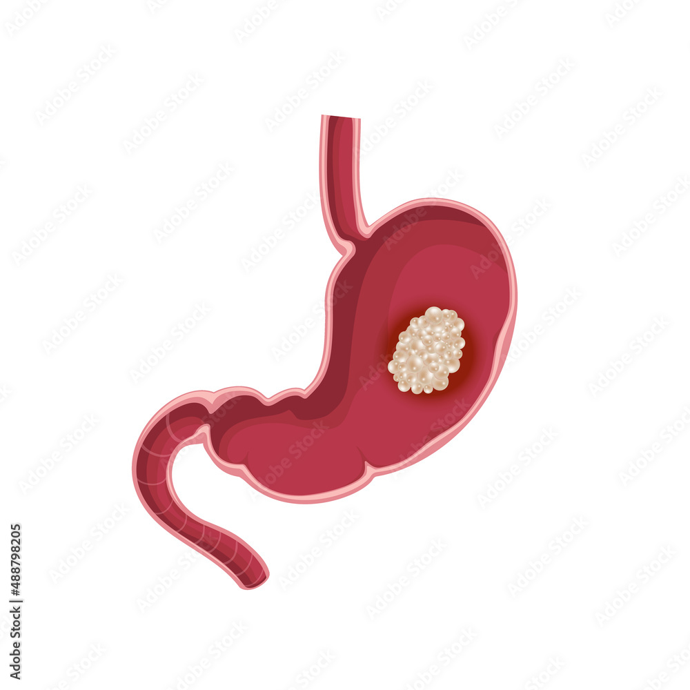 Stomach cancer. Cross section of the stomach with tumor inside Stomach cancer. Cross section of the stomach with tumor inside