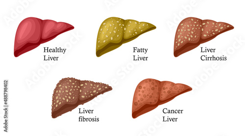 Stages of liver damage. Liver Disease. Healthy, fatty, liver fibrosis cancer and Cirrhosis. Illustration isolated on white background.
