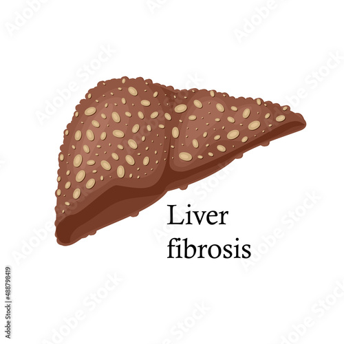 Fibrosis liver on white background cartoon illustration