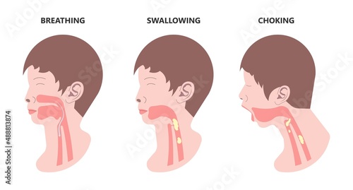 Choking first aid baby food CPR child step lodges blocking victim adult help abdomen kids conscious poster swallow back blows chest rescue breath care safety