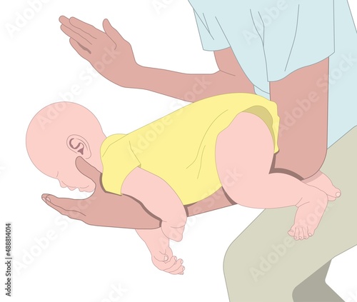 Choking first aid baby food CPR child step lodges blocking victim adult help abdomen kids conscious poster swallow back blows chest rescue breath care safety