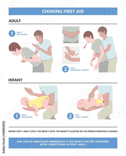 Choking first aid baby food CPR child step lodges blocking victim adult help abdomen kids conscious poster swallow back blows chest rescue breath care safety