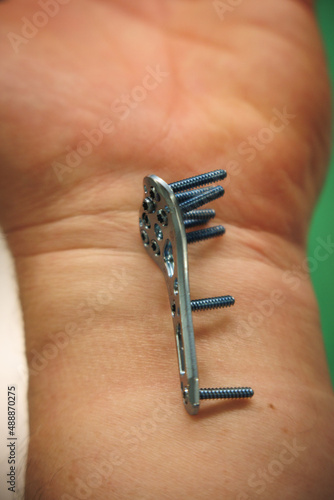 an explanted surgical blue titanium radius plate lies on the wrist