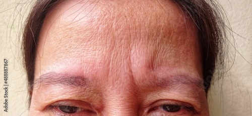 A woman 's forehead has wrinkles.