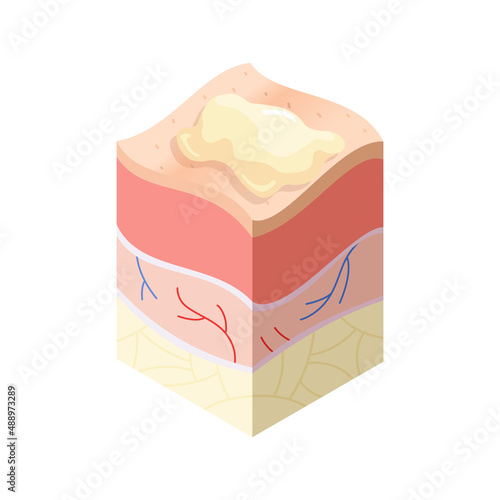 Skincare medical concept. Problems in cross-section of human skin horizontal layers structure. Anatomy illustrative model