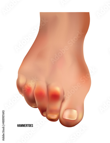 Realistic hammer toes of human leg with red pain points frontal view. photo
