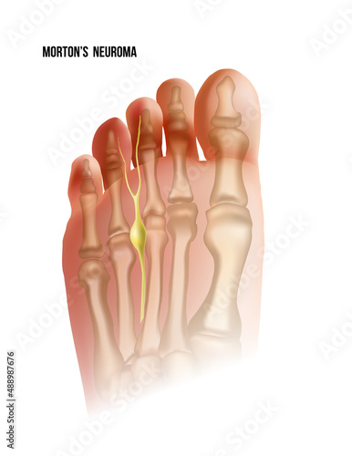 Mortons neuroma. Foot pain strain bottom view. Realistic anatomy illustration photo