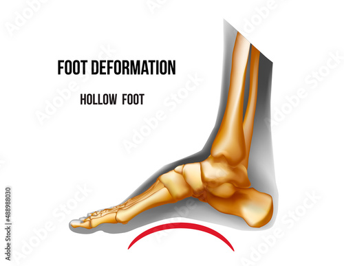 Foot hollow arch deformation. Bones skeleton realistic anatomy illustration