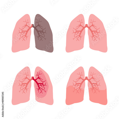 healthy and diseased lungs