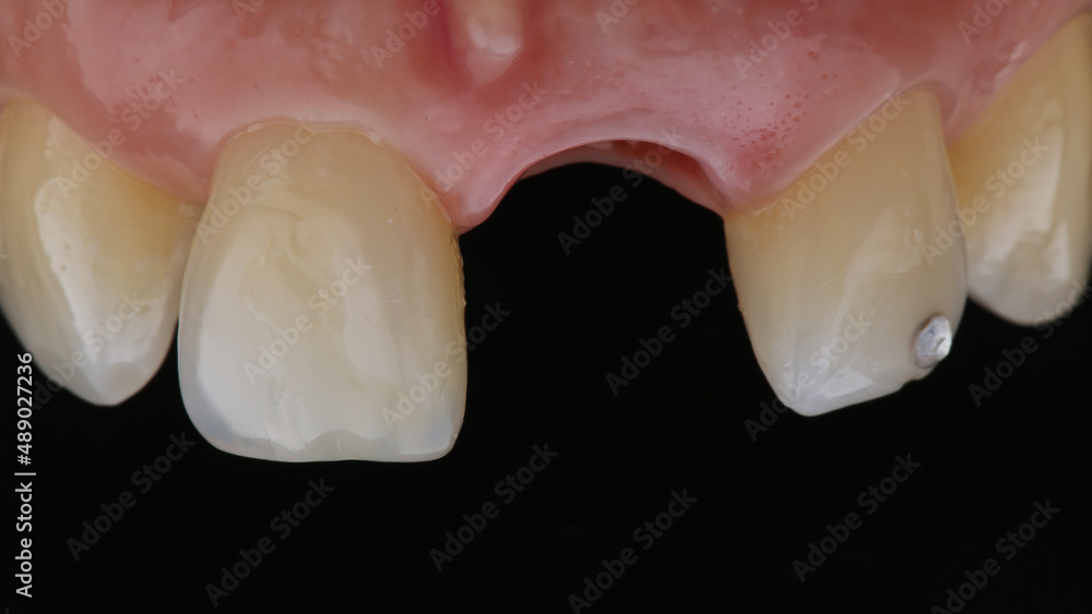 dental macro photo with a missing central tooth after implantation