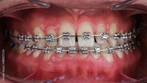 beautiful photo of a smile with braces after professional dental hygiene