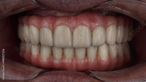 dental prostheses made of ceramics and titanium in the bite of the upper and lower jaws with excellent gums