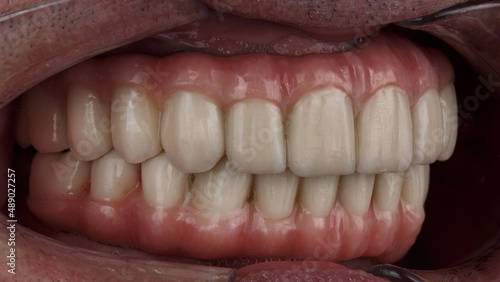 side view of dental prostheses made of ceramics in the bite of the upper and lower jaws with gums