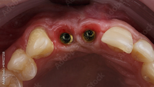 two installed dental abutments on implants in the area of two central teeth