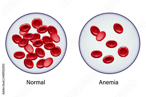 Diagram of comparison between normal red blood cells and anemia.