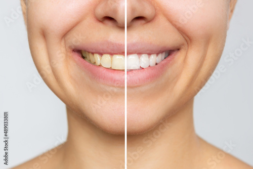 Cropped shot of a young smiling woman before and after teeth whitening isolated on a gray background. Dark tooth enamel, contrast. Dentistry, dental care