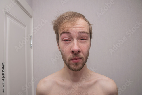 The face of a man with a puffy red eye with tears from injury, conjunctivitis