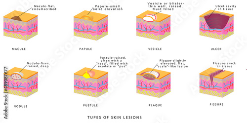 Types of skin lesions. Dermatology - Primary & Secondary Skin lesions. Skin Lesion - Cyst, Fissure, Macule, Nodule, Papule, Polyp, Pustule, Vesicle, Wheal 

