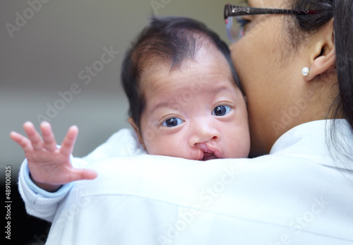 She is safe in her mothers arms. Portrait of a baby girl who has a cleft palate looking over the shoulder of her mother. photo