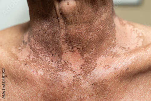 Male patient with tangue cancer who has actinic changes after radiotherapy photo