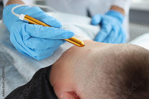 A doctor removes a wart from a man s neck  close-up
