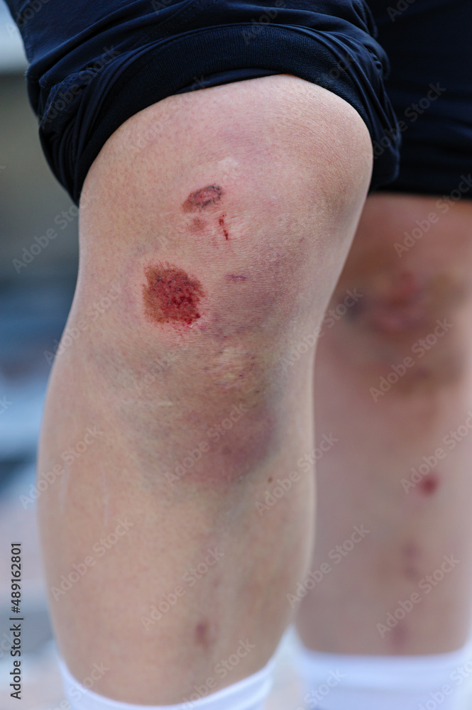 Sports injury, skateboarder with injured knees Sports injury, skateboarder with injured knees