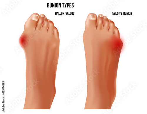 Artritic tailors bunion and hallux valgus foot bunion rheumatoid sore joints, top view.