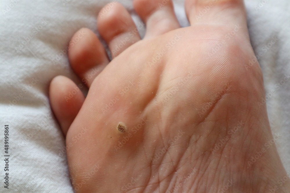 Close-up of an extensive wart on an adult foot Close-up of an extensive wart on an adult foot
