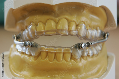 Abdruck eines Kiefers mit einer Zahnspange 